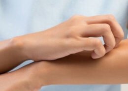 Akut Ürtiker Teşhisi Nasıl Konulur